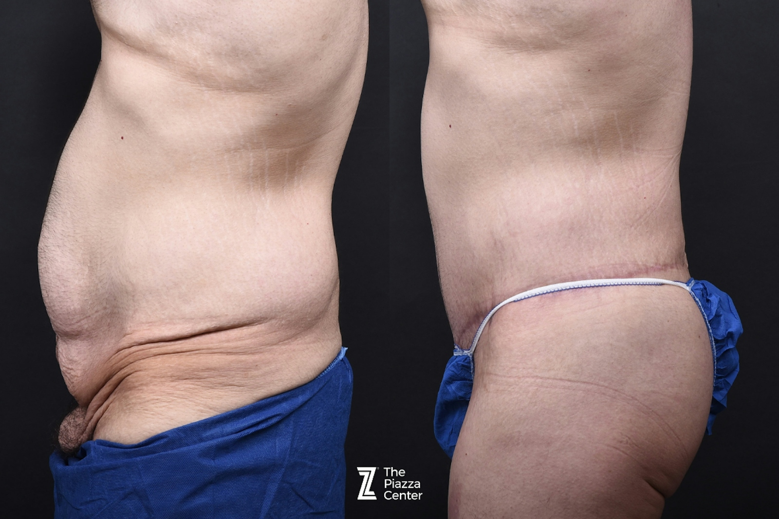 Austin Liposuction Before & After Gallery - Patient 313599 - Image 4 - The Piazza Center