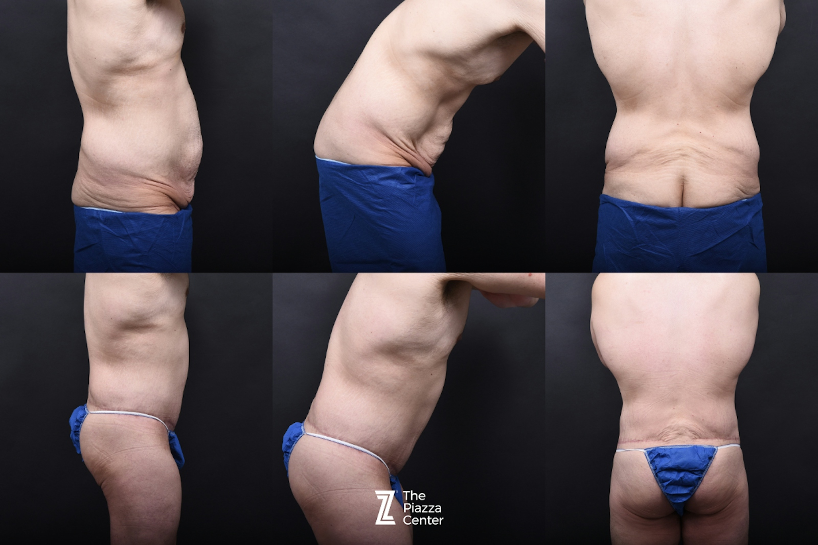Austin Liposuction Before & After Gallery - Patient 313599 - Image 8 - The Piazza Center