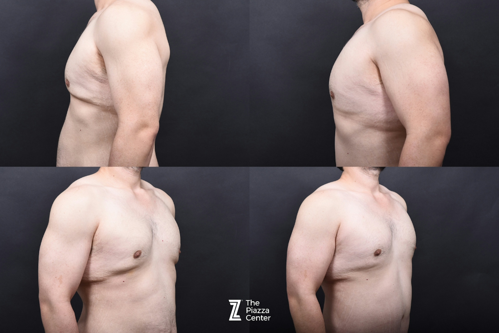 Austin Liposuction Before & After Gallery - Patient 313599 - Image 10 - The Piazza Center