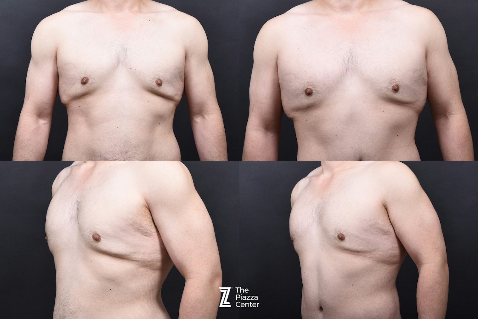 Austin Liposuction Before & After Gallery - Patient 313599 - Image 9 - The Piazza Center