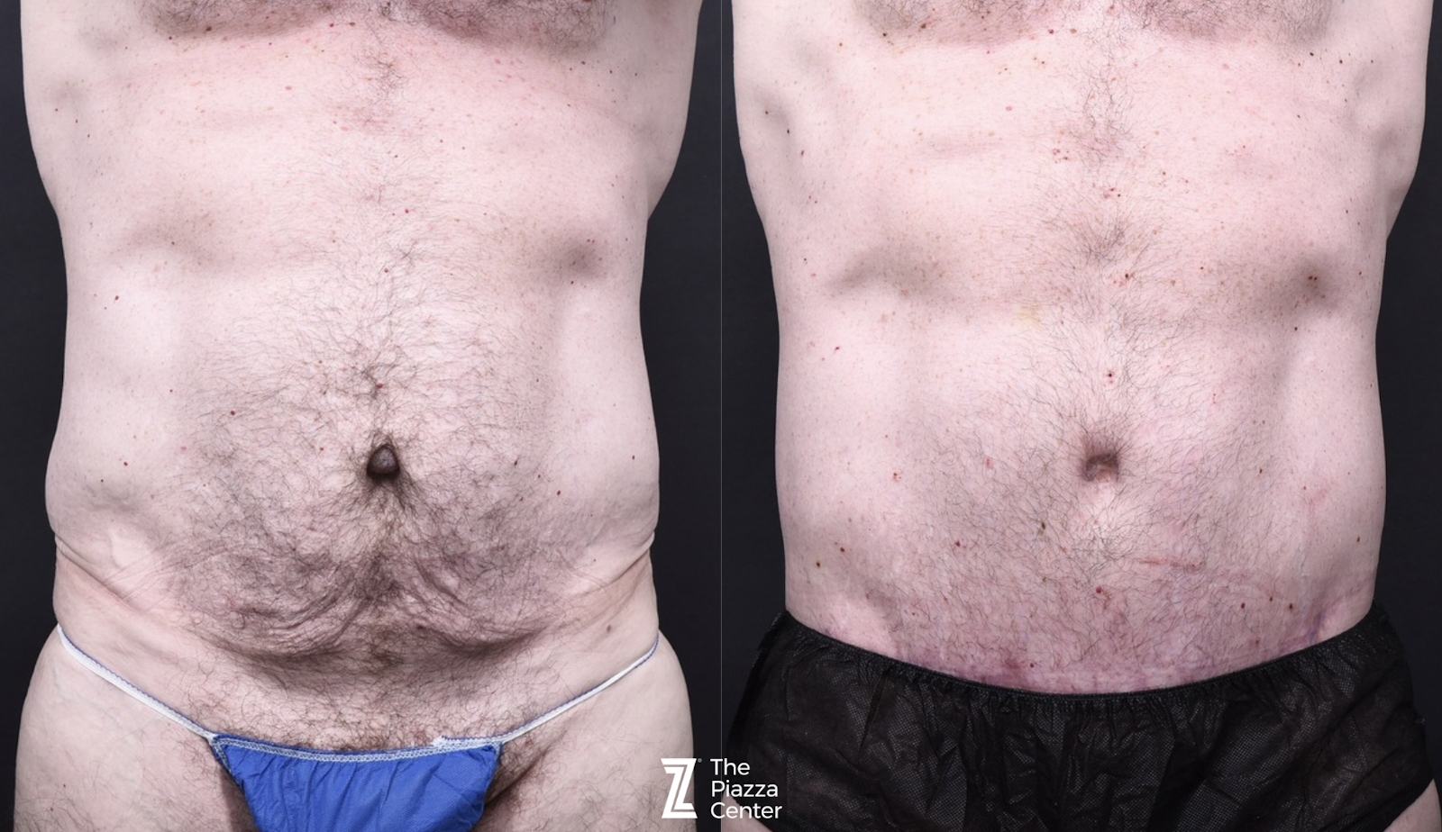 Austin Liposuction Before & After Gallery - Patient 294040 - Image 1 - The Piazza Center