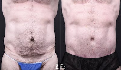 Austin Liposuction Before & After Gallery - Patient 294040 - Image 1 - The Piazza Center
