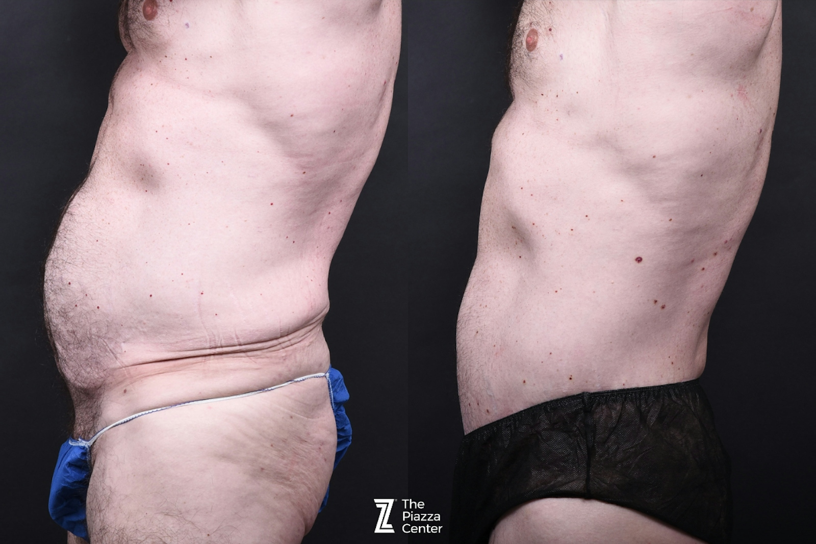 Austin Liposuction Before & After Gallery - Patient 294040 - Image 2 - The Piazza Center