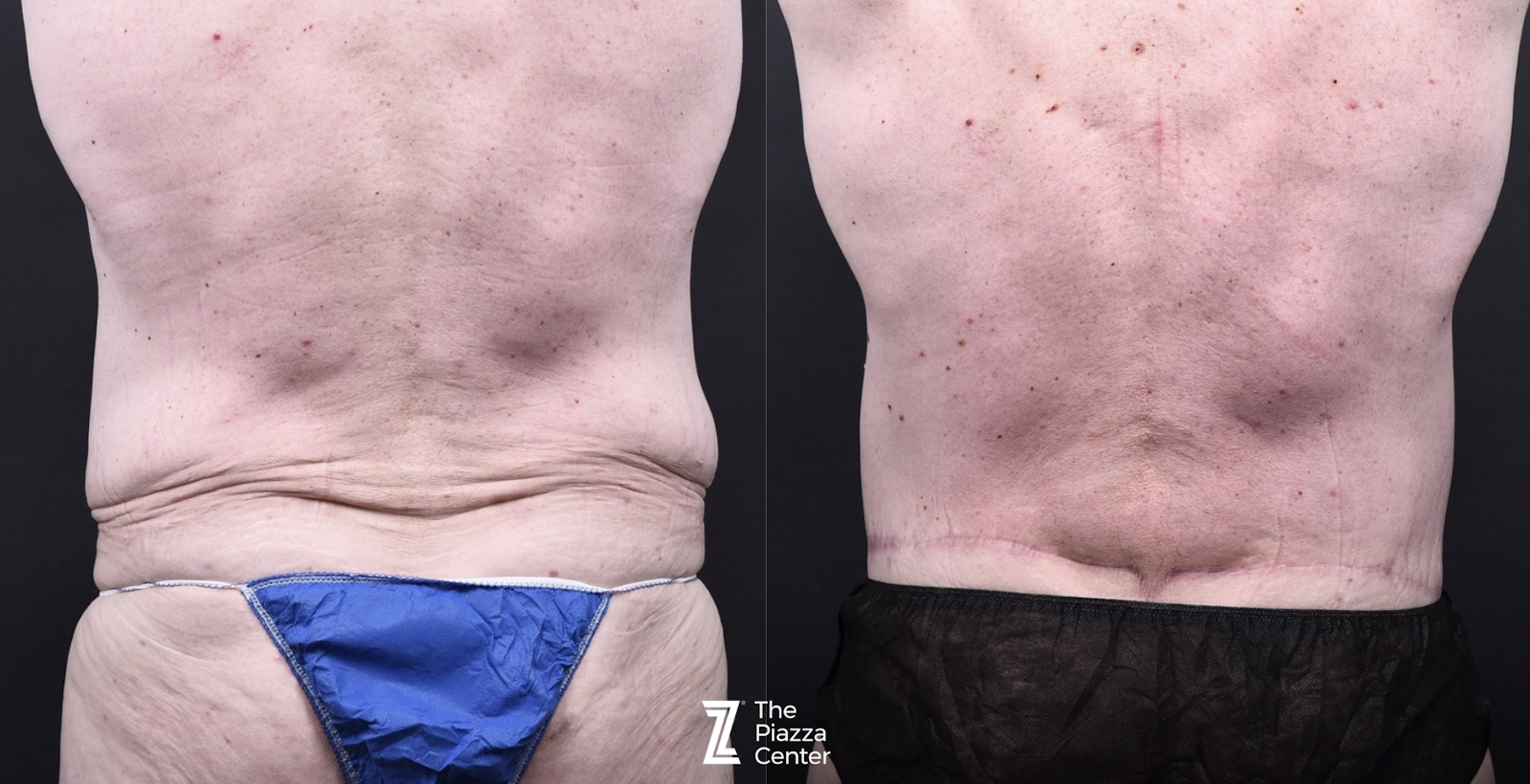 Austin Liposuction Before & After Gallery - Patient 294040 - Image 3 - The Piazza Center