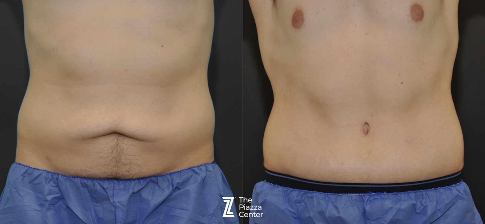 Austin Liposuction Before & After Gallery - Patient 403530 - Image 1 - The Piazza Center