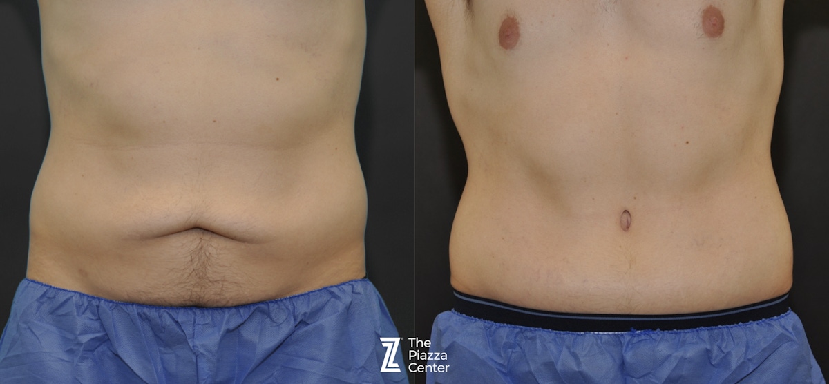 Austin Tummy Tuck Before & After Gallery - Patient 166370 - Image 1 - The Piazza Center