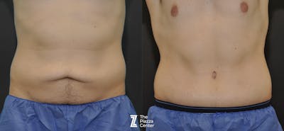 Austin Liposuction Before & After Gallery - Patient 403530 - Image 1 - The Piazza Center