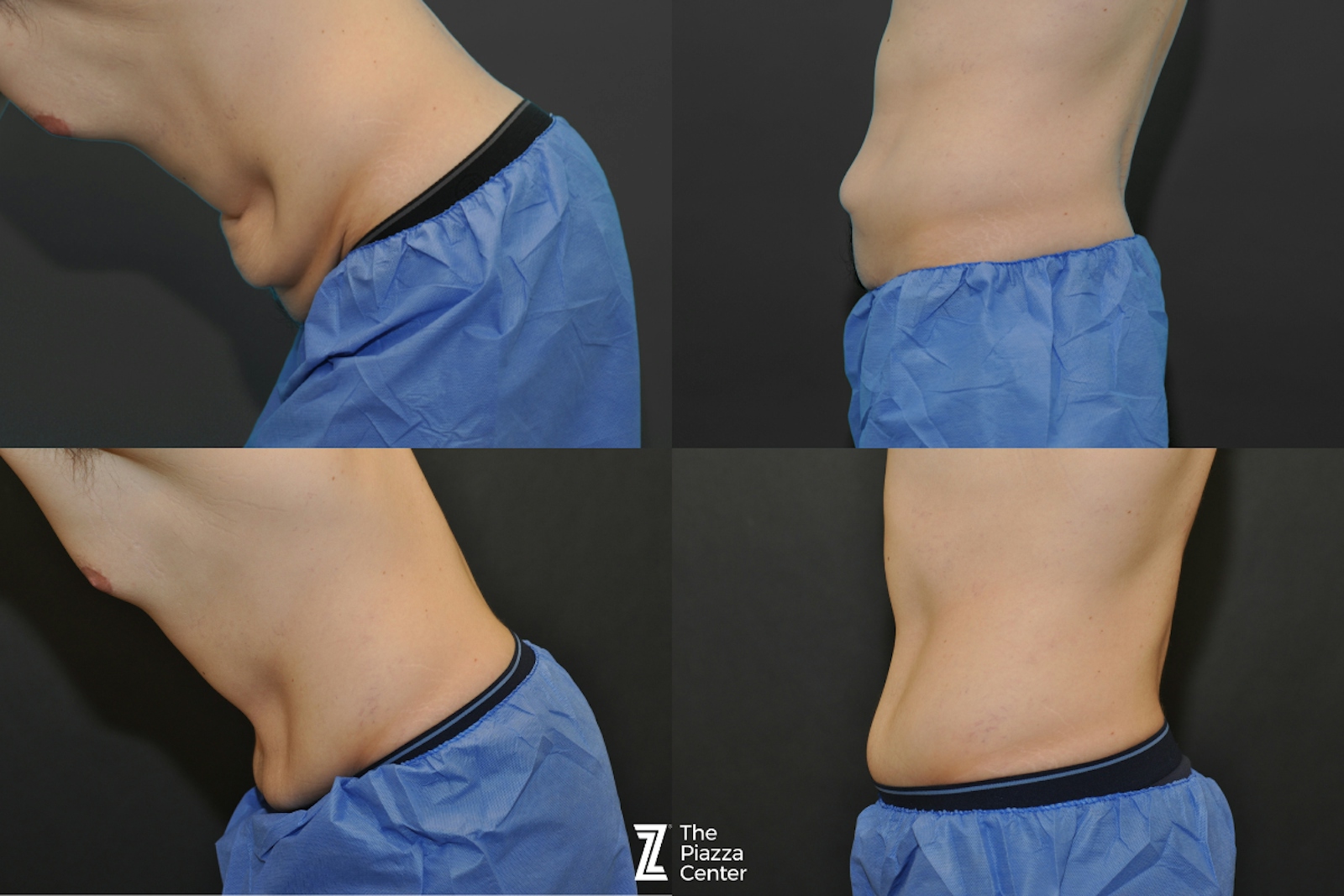 Austin Liposuction Before & After Gallery - Patient 403530 - Image 2 - The Piazza Center