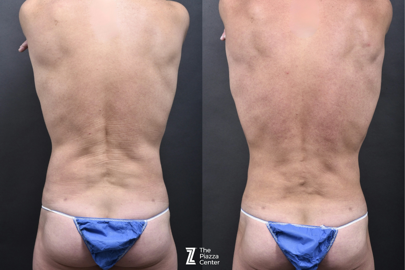 Austin Liposuction Before & After Gallery - Patient 355670 - Image 4 - The Piazza Center