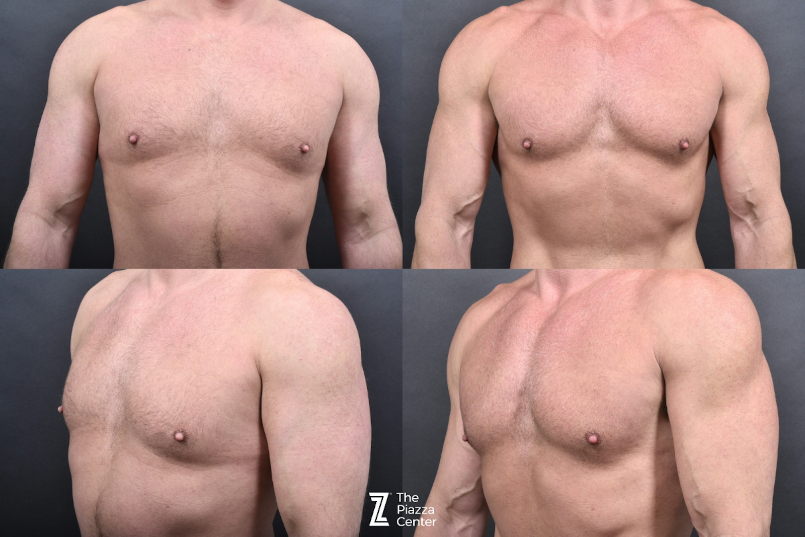 Austin Liposuction Before & After Gallery - Patient 355670 - Image 7 - The Piazza Center