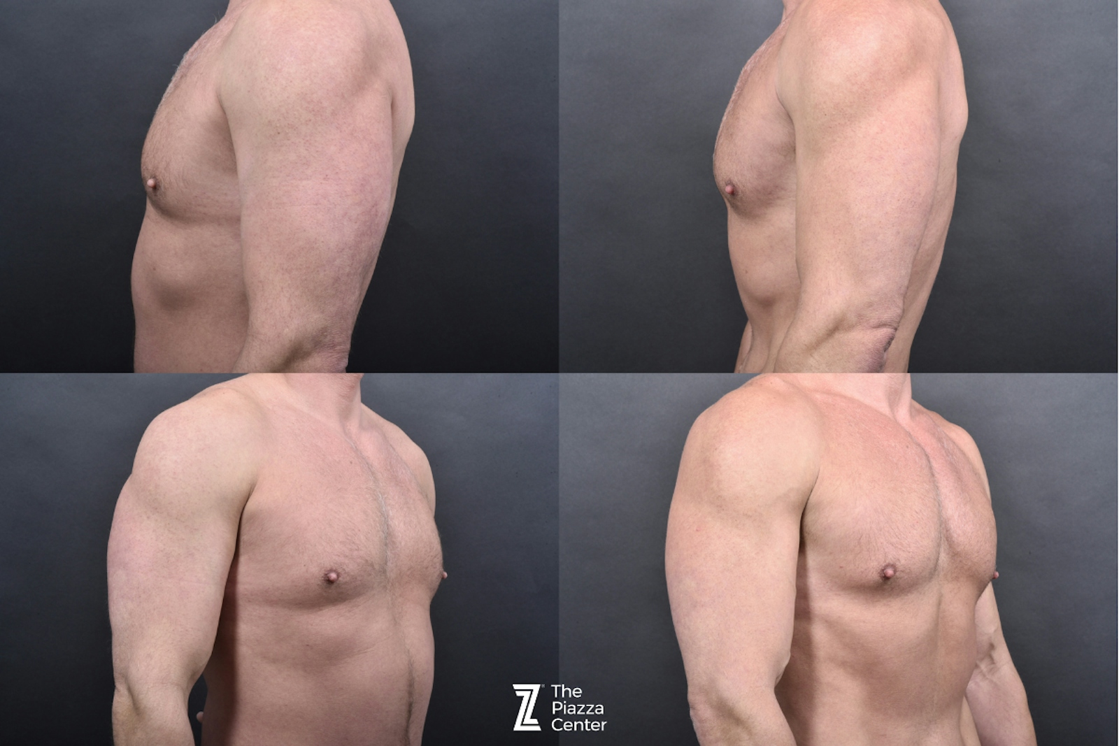 Austin Liposuction Before & After Gallery - Patient 355670 - Image 6 - The Piazza Center