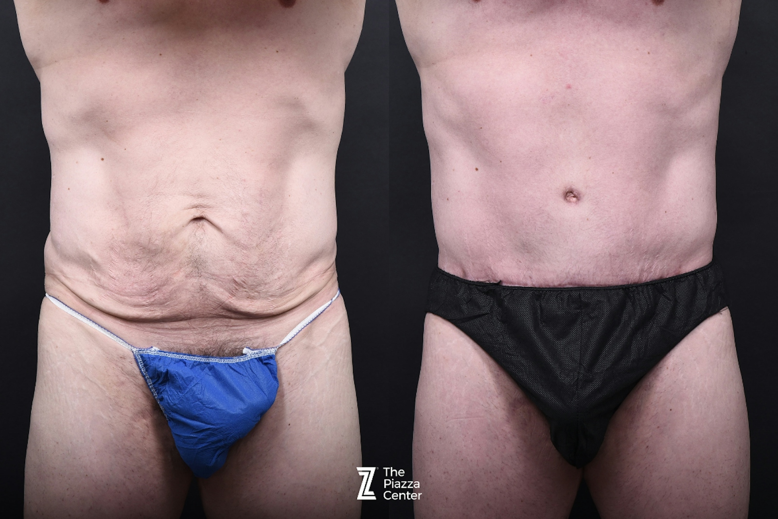 Austin Liposuction Before & After Gallery - Patient 260024 - Image 1 - The Piazza Center