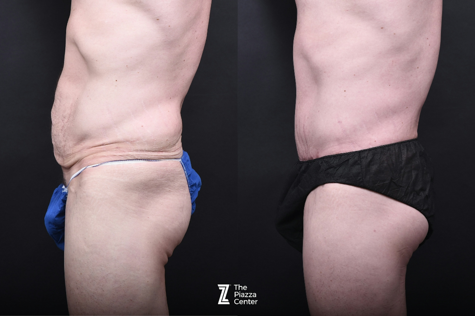 Austin Liposuction Before & After Gallery - Patient 260024 - Image 4 - The Piazza Center