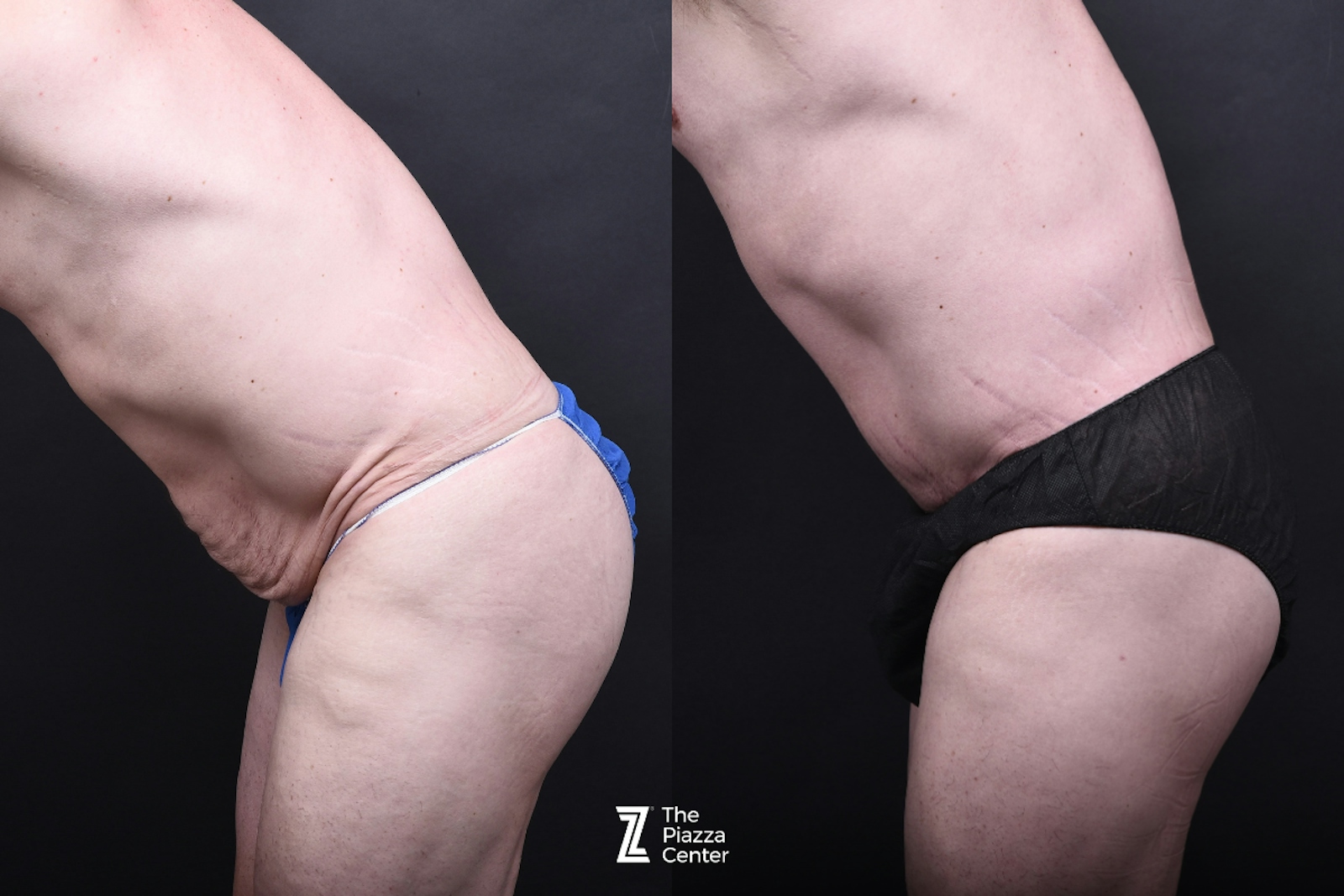 Austin Liposuction Before & After Gallery - Patient 260024 - Image 5 - The Piazza Center