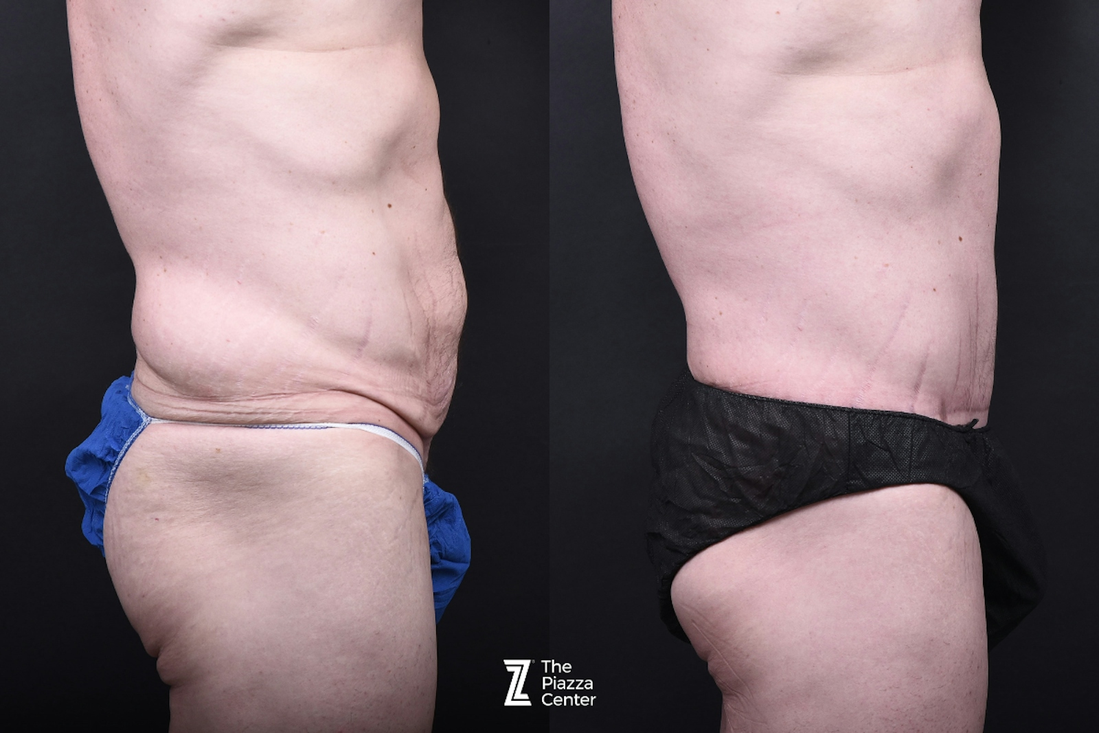 Austin Liposuction Before & After Gallery - Patient 260024 - Image 2 - The Piazza Center