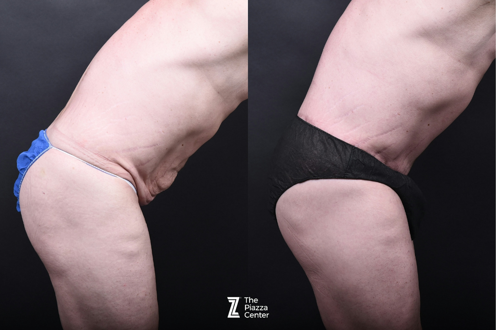 Austin Liposuction Before & After Gallery - Patient 260024 - Image 3 - The Piazza Center