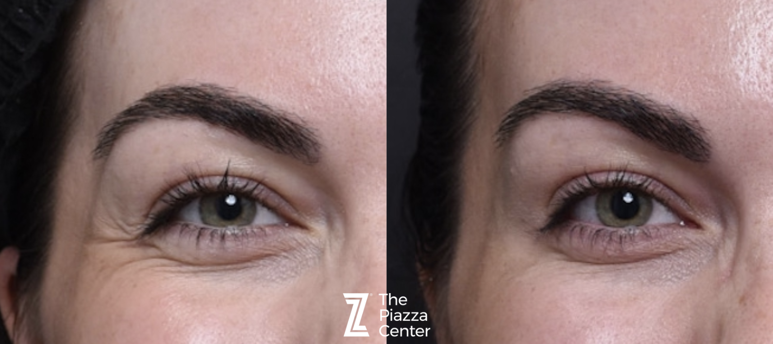 Getting rid of crows feet with Dysport