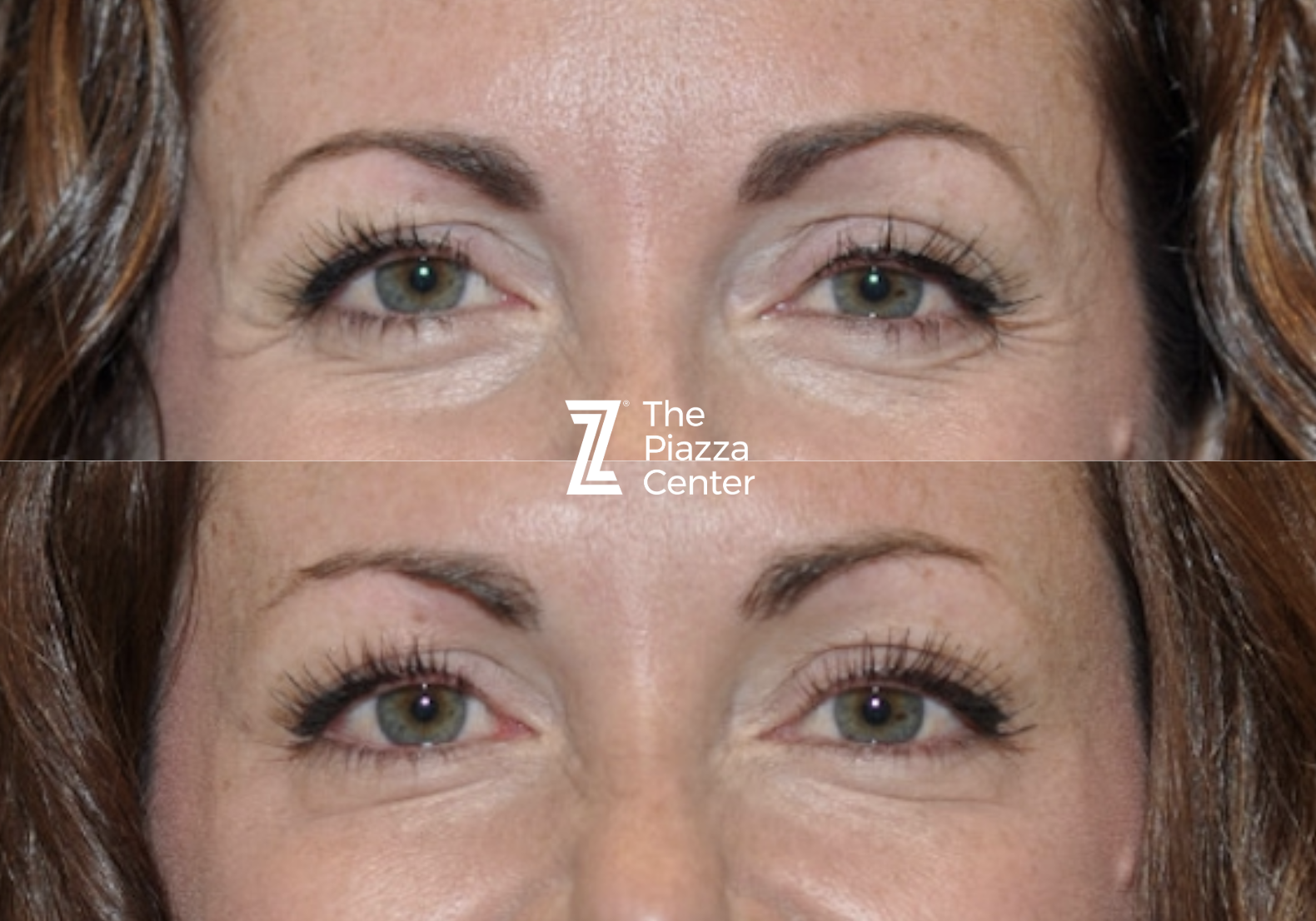 Crow's Feet Solution with Botox