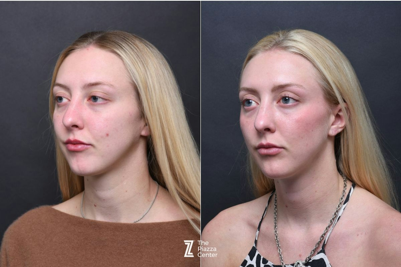 Austin Wrinkle Relaxers Before & After Gallery - Patient 119754 - Image 2 - The Piazza Center