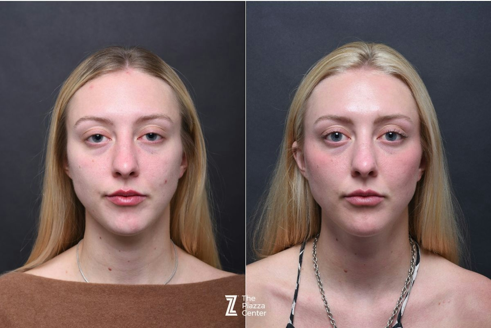 Austin Wrinkle Relaxers Before & After Gallery - Patient 119754 - Image 1 - The Piazza Center