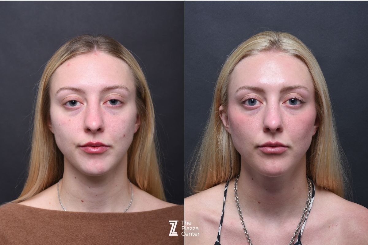 Austin Facial Rejuvenation Before & After Gallery - Patient 229953 - Image 1 - The Piazza Center