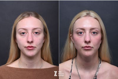 Austin Injectable Fillers Before & After Gallery - Patient 383581 - Image 1 - The Piazza Center