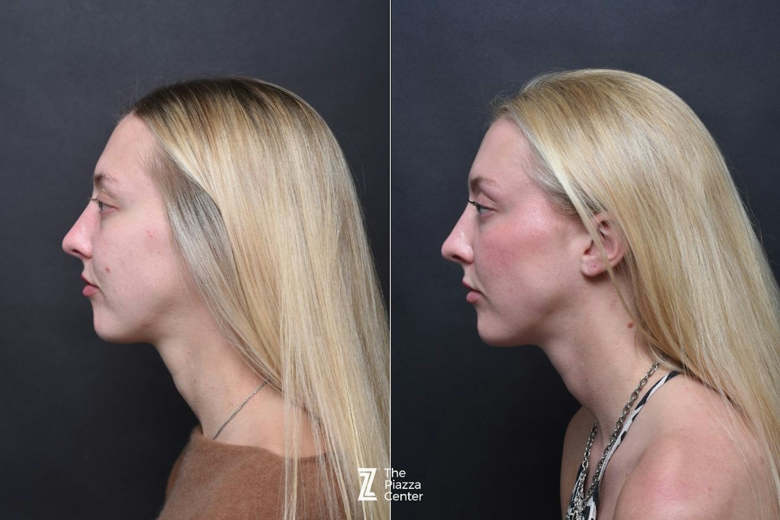 Austin Wrinkle Relaxers Before & After Gallery - Patient 119754 - Image 3 - The Piazza Center