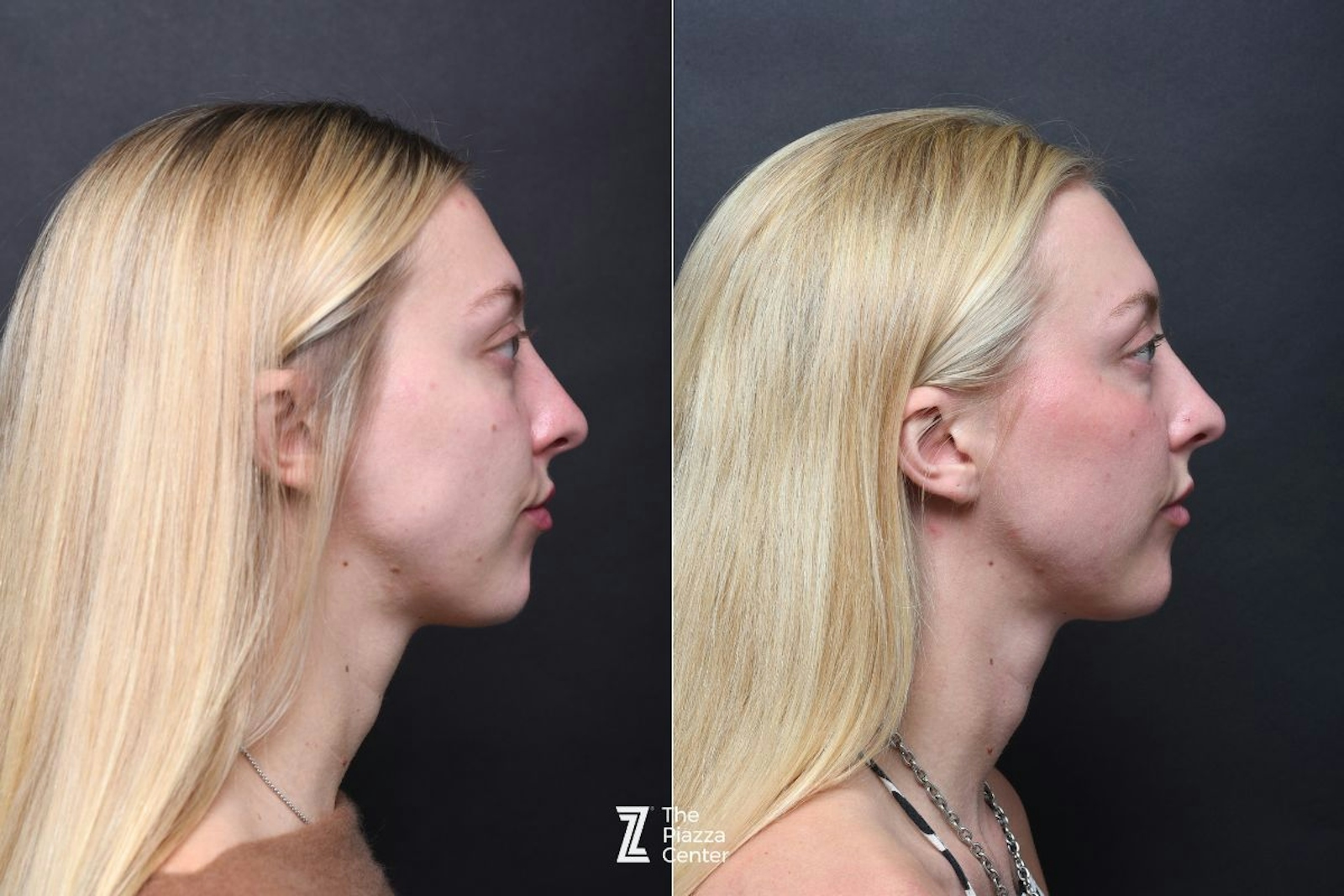 Austin Wrinkle Relaxers Before & After Gallery - Patient 119754 - Image 4 - The Piazza Center