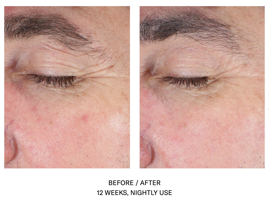 Crows Feet treatment with SkinBetter Eye Cream