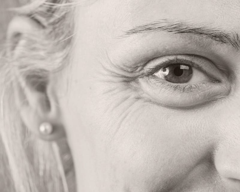 How to Get rid of Crows Feet Eye wrinkles