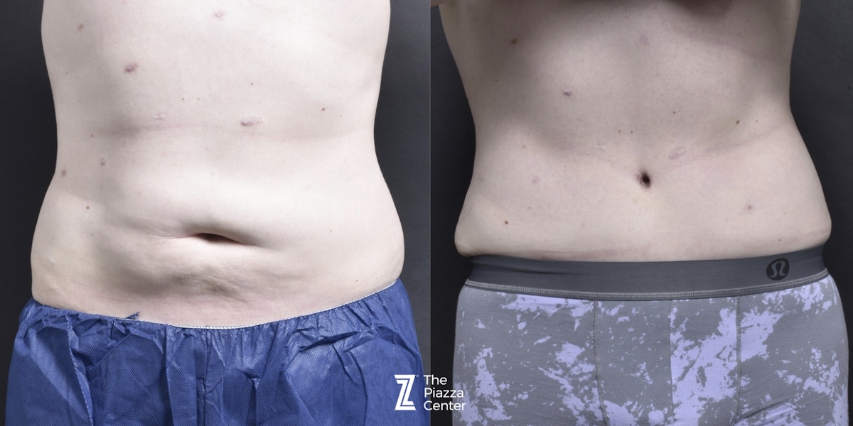 Austin Male Body Contouring Before & After Gallery - Patient 352011 - Image 1 - The Piazza Center