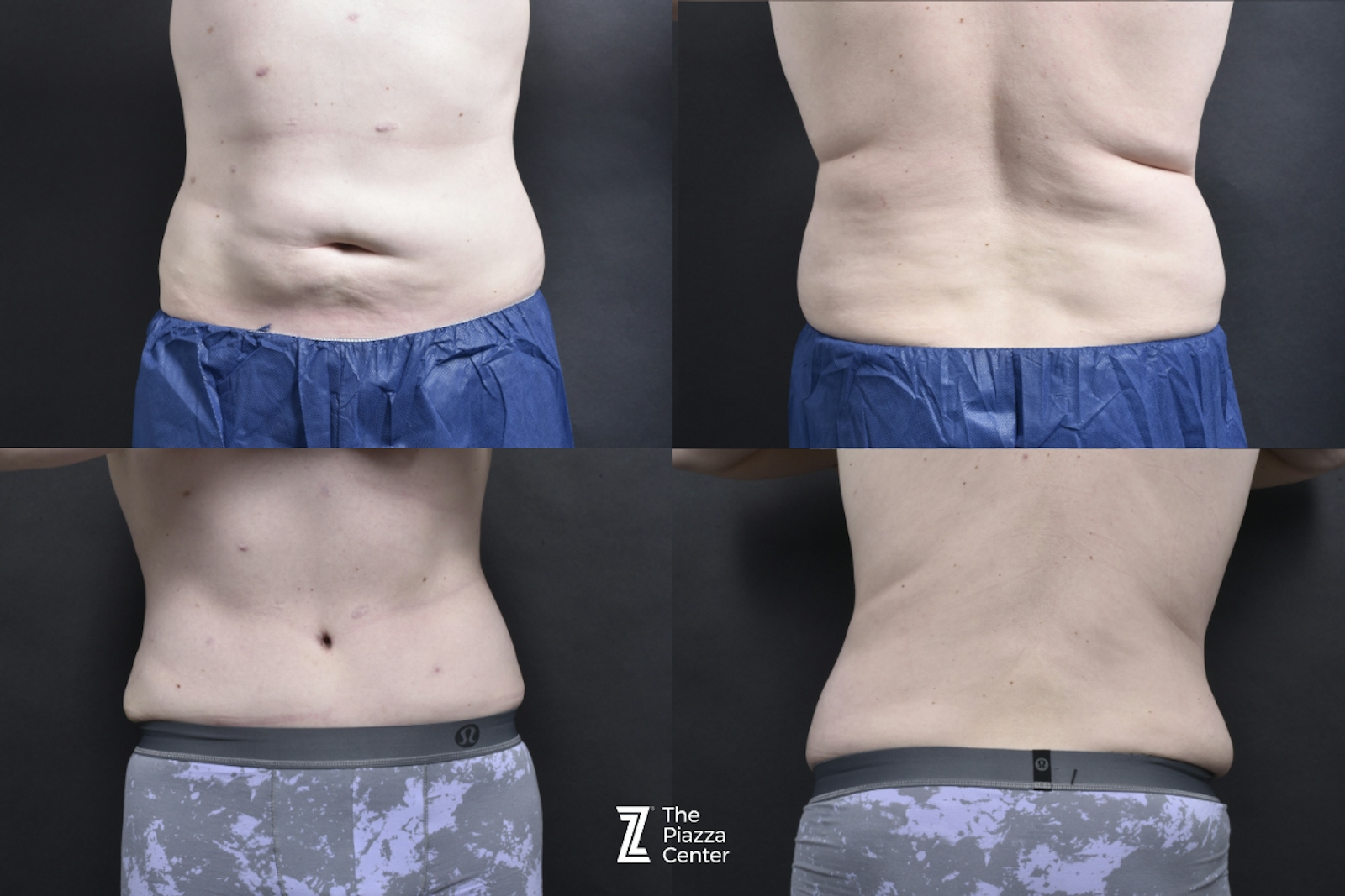 Austin Male Body Contouring Before & After Gallery - Patient 352011 - Image 2 - The Piazza Center