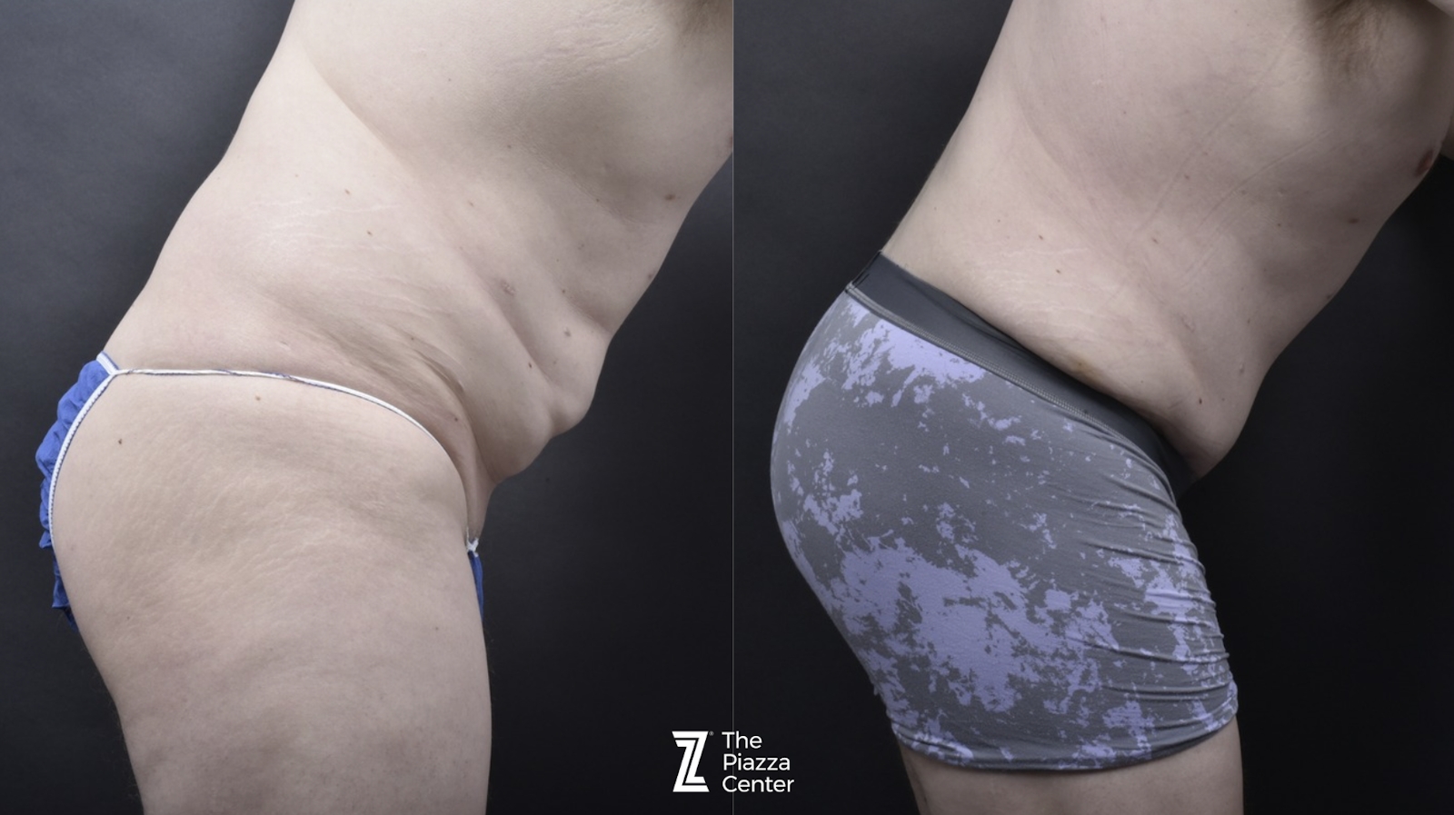 Austin Male Body Contouring Before & After Gallery - Patient 352011 - Image 3 - The Piazza Center