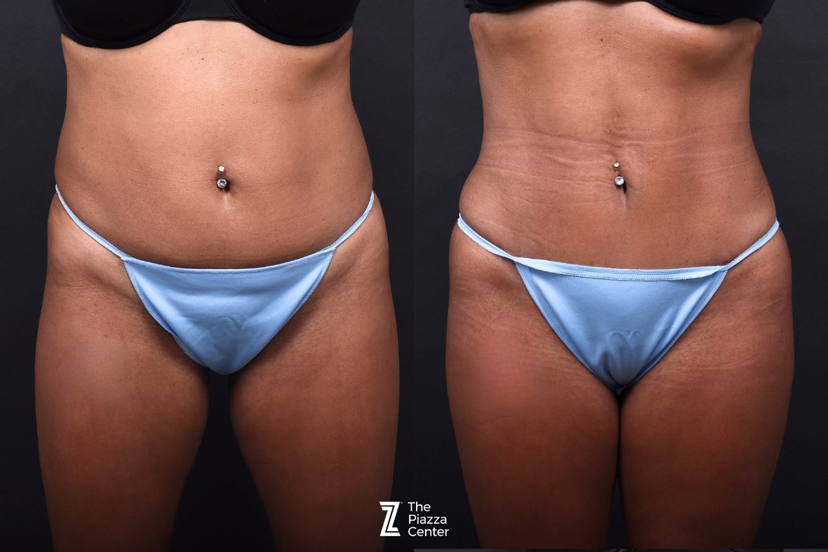 Austin Liposuction Before & After Gallery - Patient 495412 - Image 1 - The Piazza Center