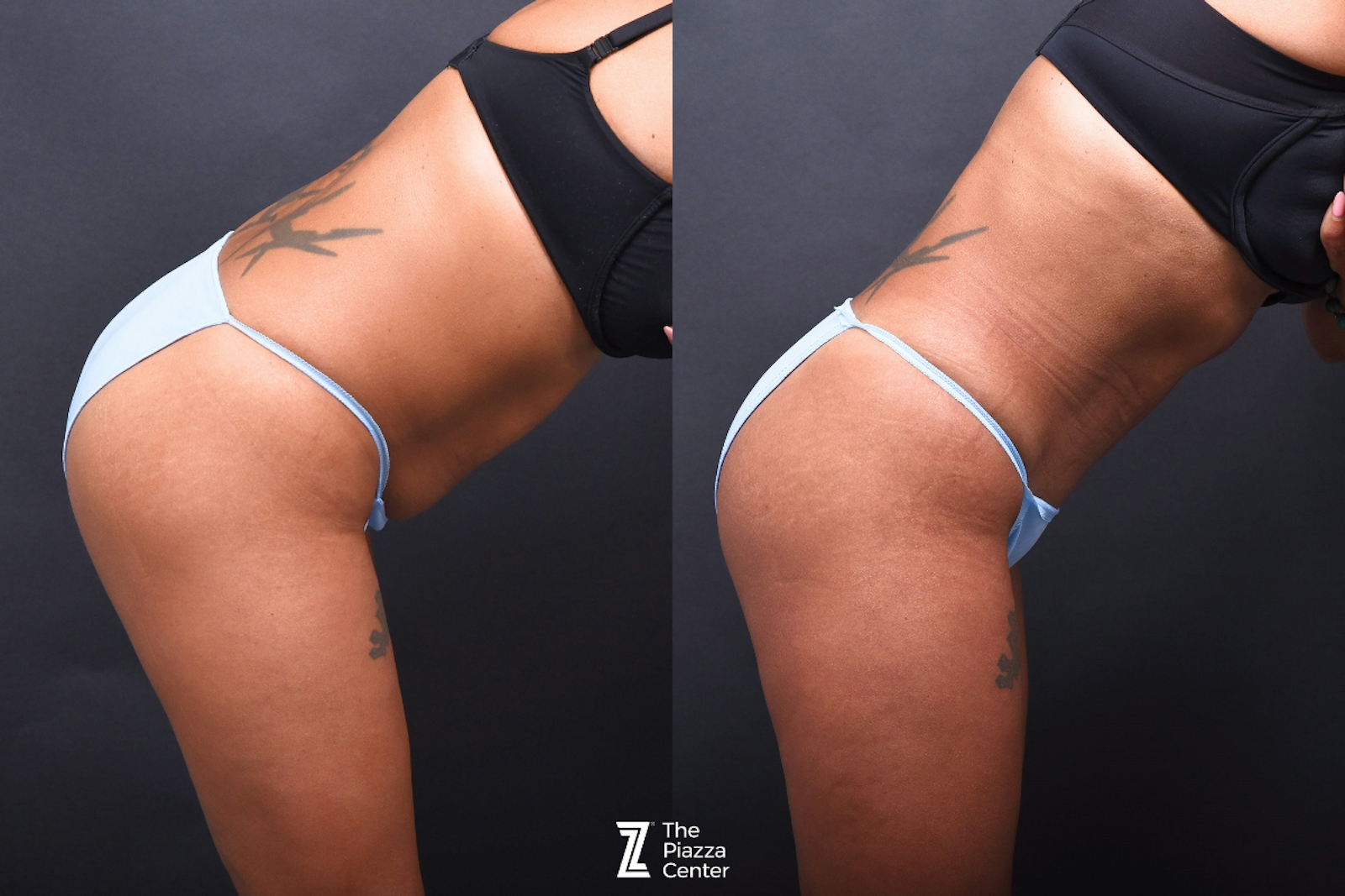 Austin Liposuction Before & After Gallery - Patient 495412 - Image 3 - The Piazza Center