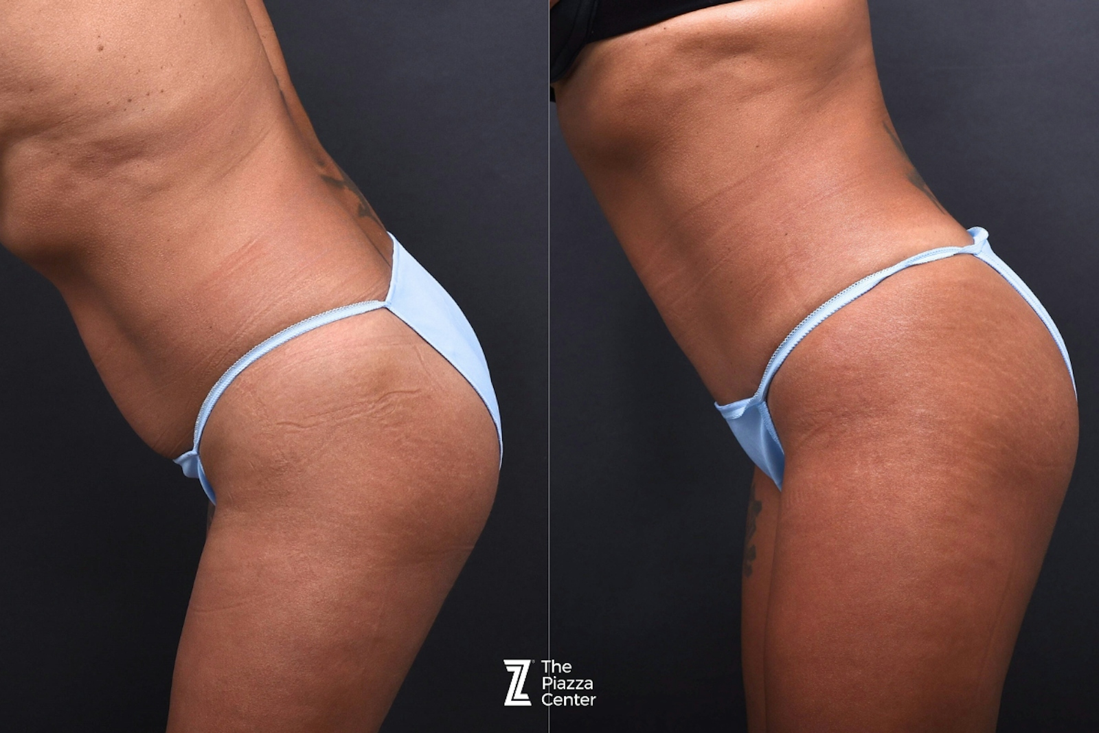 Austin Liposuction Before & After Gallery - Patient 495412 - Image 4 - The Piazza Center