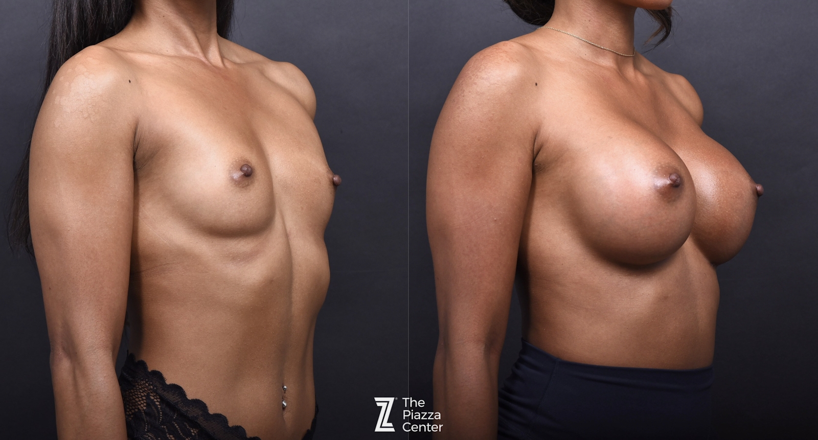 Austin Breast Augmentation Before & After Gallery - Patient 970520 - Image 2 - The Piazza Center
