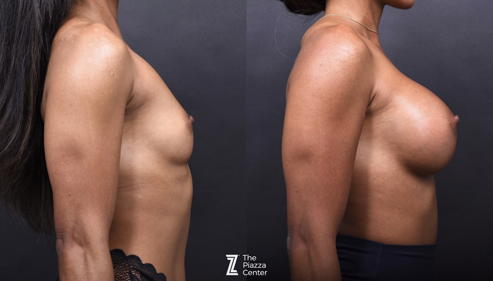 Austin Breast Augmentation Before & After Gallery - Patient 970520 - Image 3 - The Piazza Center