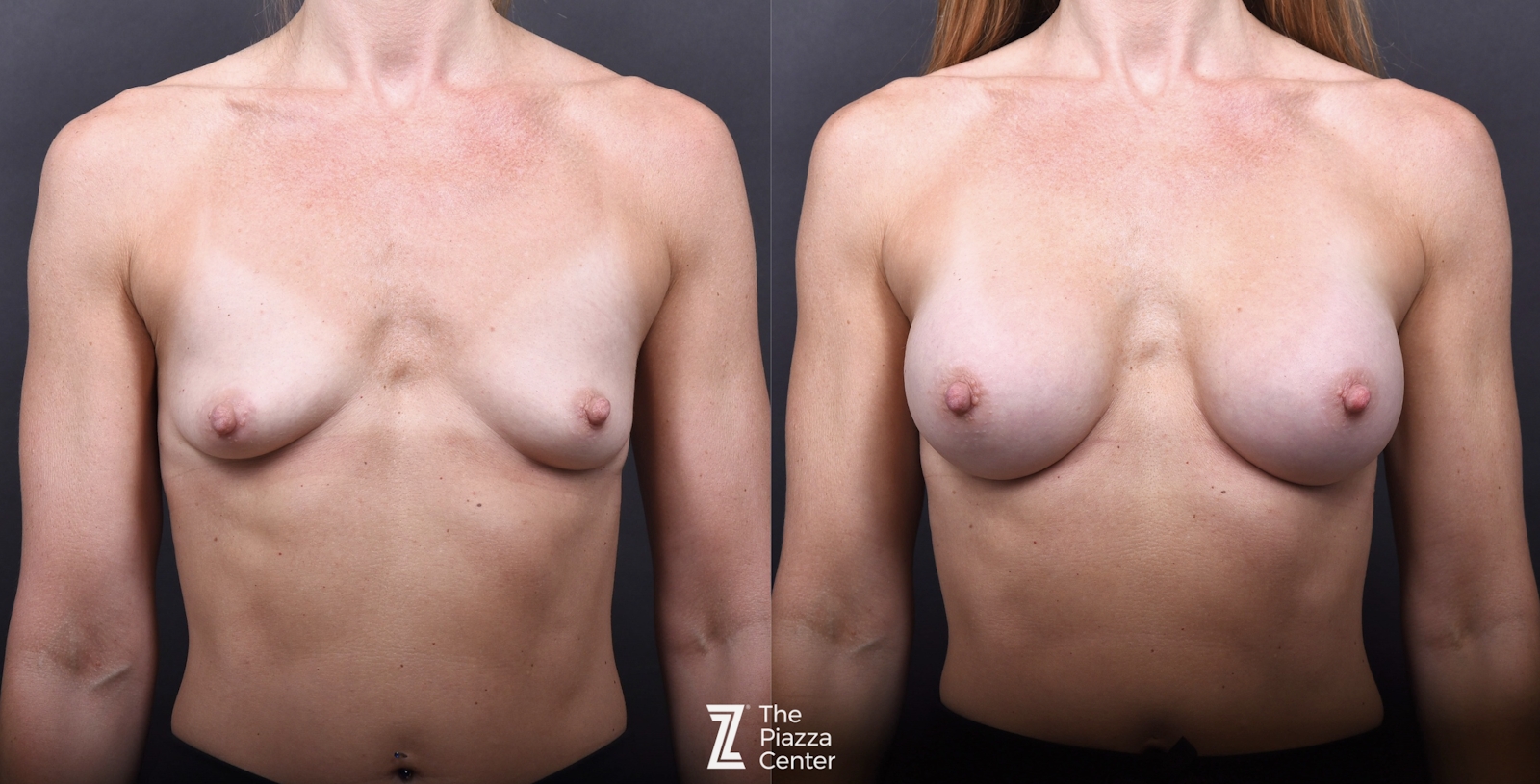 Austin Motiva Implants Before & After Gallery - Patient 245459 - Image 1 - The Piazza Center