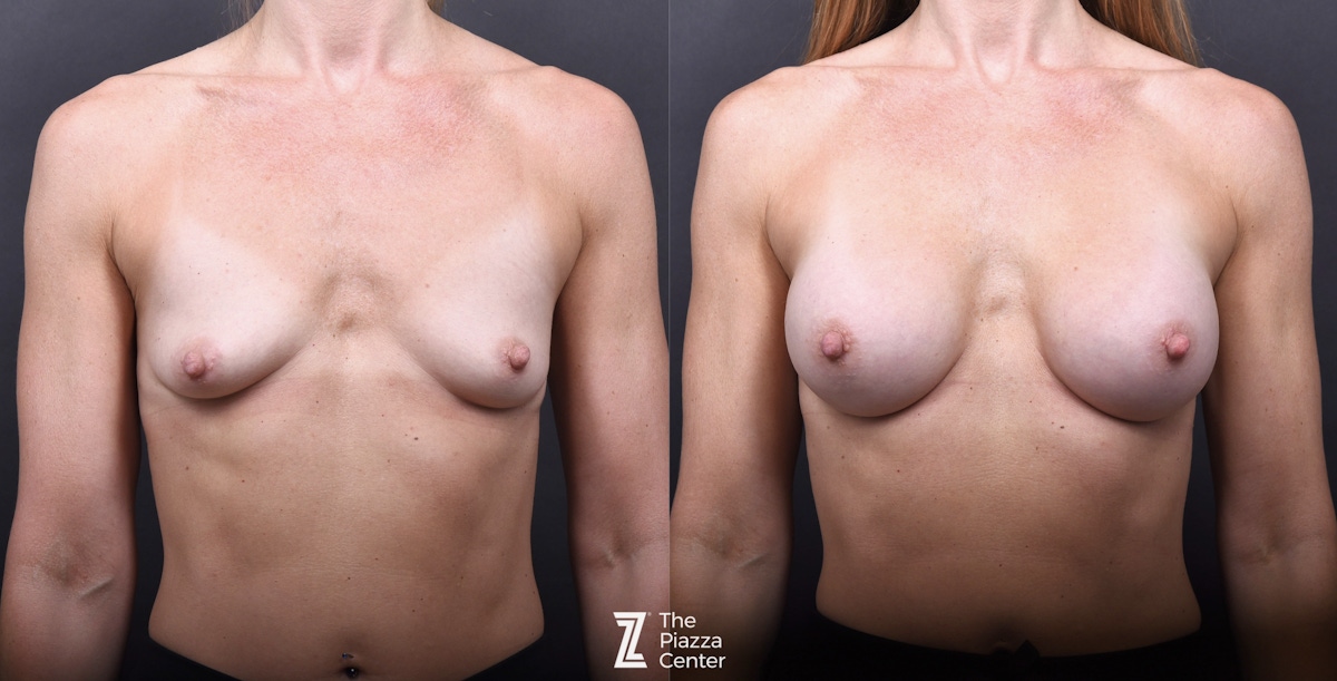 Austin Motiva Implants Before & After Gallery - Patient 245459 - Image 1 - The Piazza Center