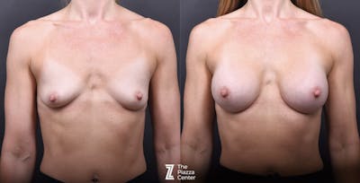 Austin Breast Augmentation Before & After Gallery - Patient 428919 - Image 1 - The Piazza Center