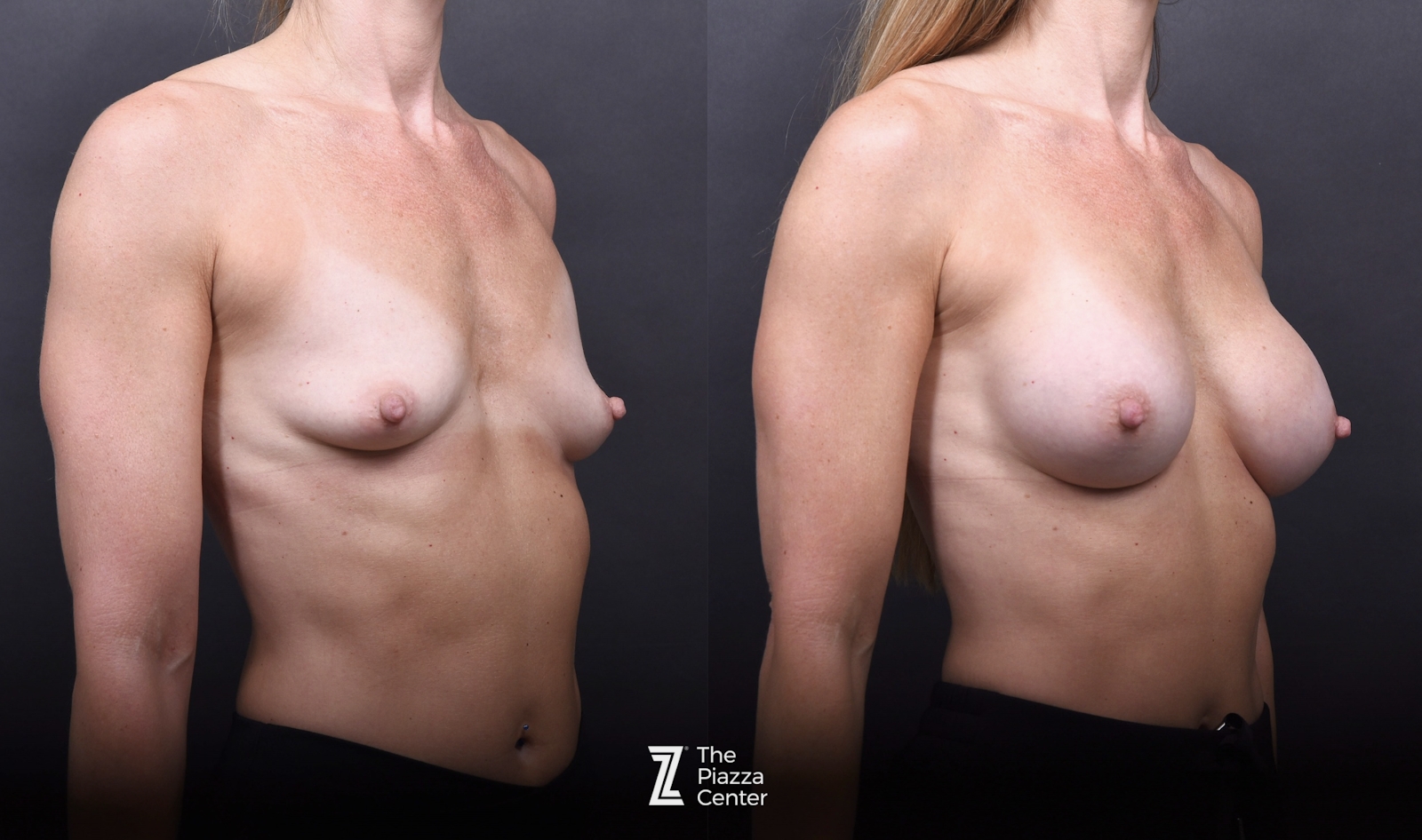 Austin Motiva Implants Before & After Gallery - Patient 245459 - Image 2 - The Piazza Center