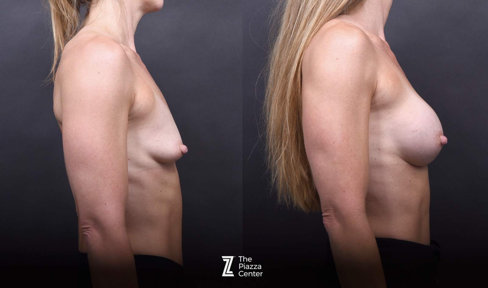 Austin Motiva Implants Before & After Gallery - Patient 245459 - Image 3 - The Piazza Center