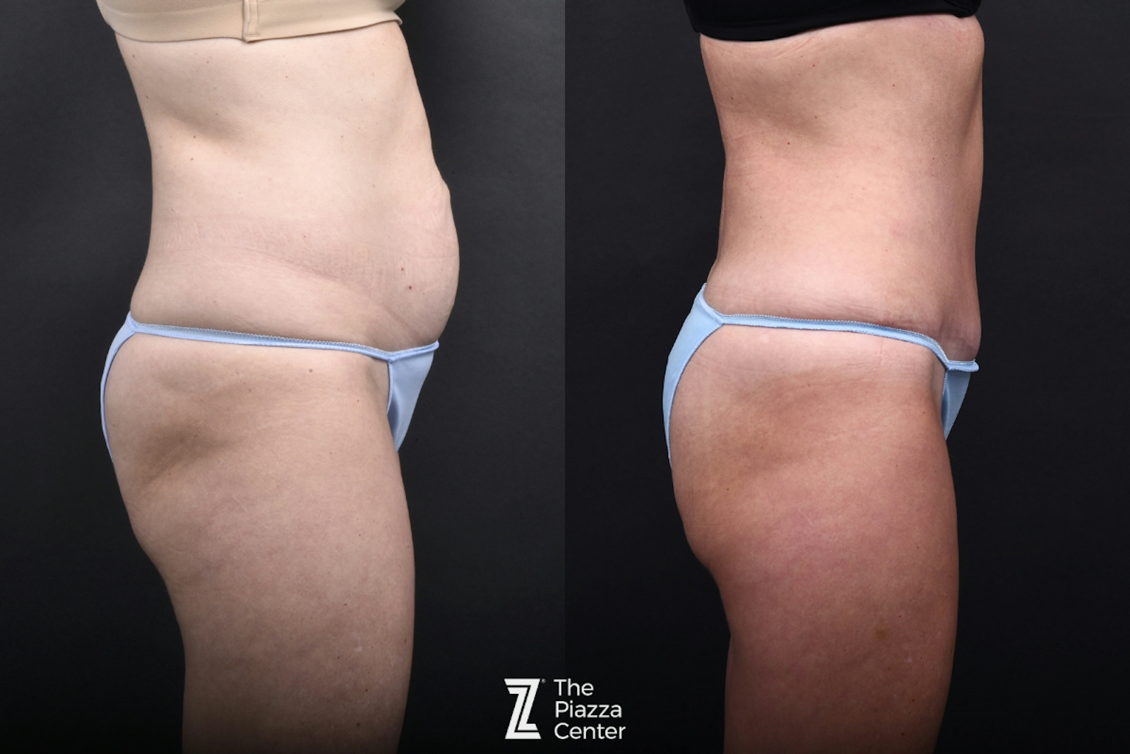 Austin Liposuction Before & After Gallery - Patient 260024 - Image 2 - The Piazza Center