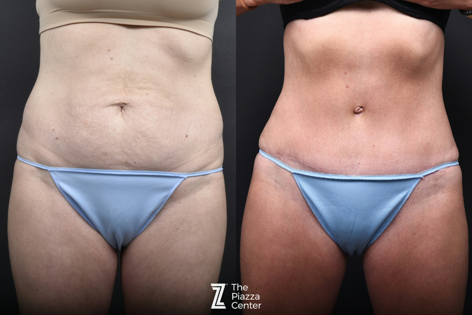 Austin Liposuction Before & After Gallery - Patient 260024 - Image 1 - The Piazza Center