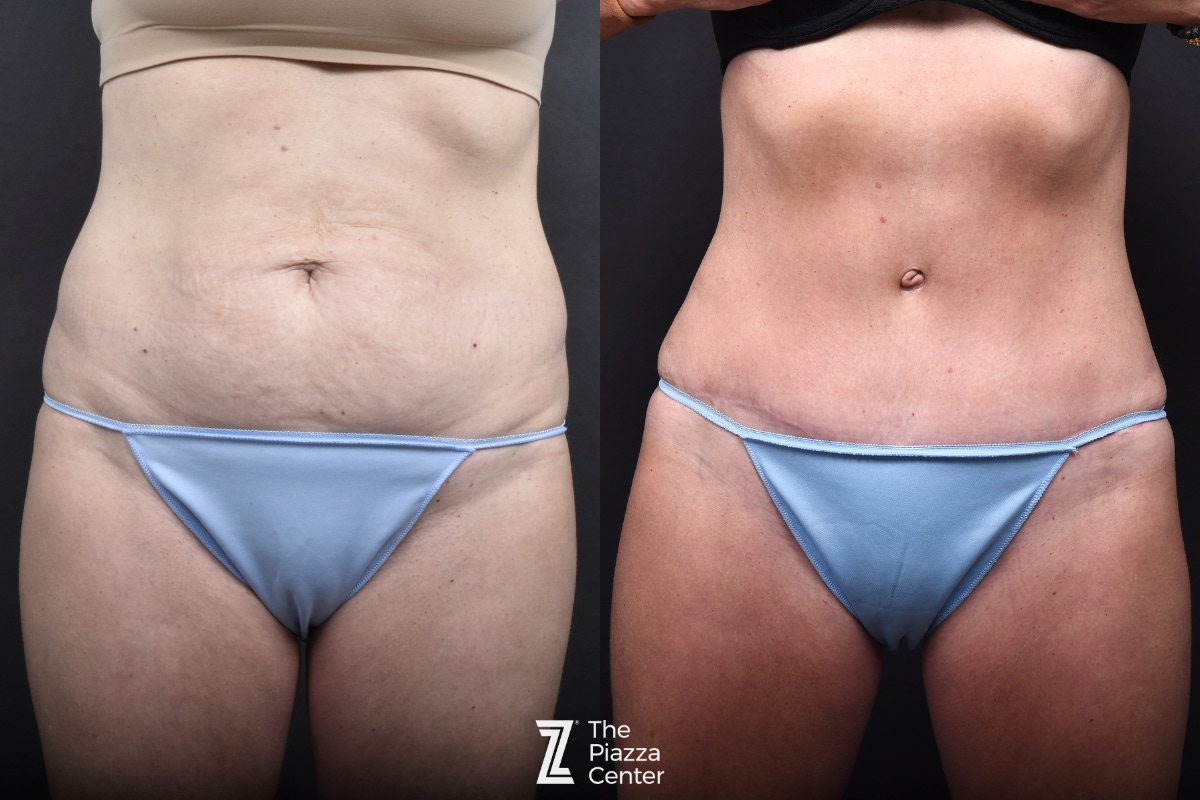 Austin Liposuction Before & After Gallery - Patient 260024 - Image 1 - The Piazza Center