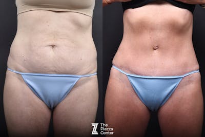 Austin Liposuction Before & After Gallery - Patient 260024 - Image 1 - The Piazza Center