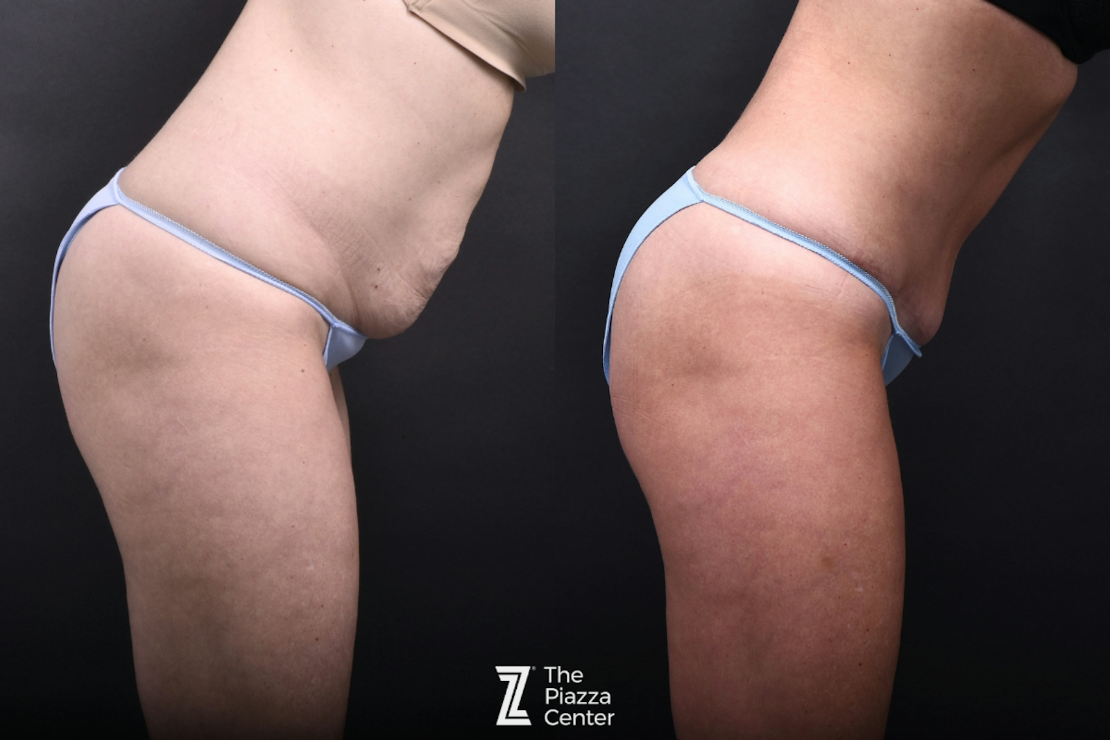 Austin Liposuction Before & After Gallery - Patient 260024 - Image 3 - The Piazza Center