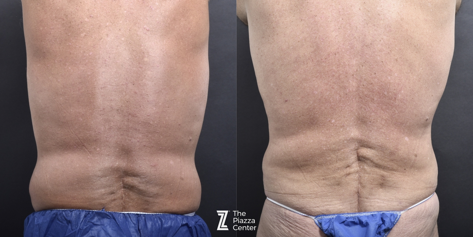Austin Liposuction Before & After Gallery - Patient 182165 - Image 4 - The Piazza Center