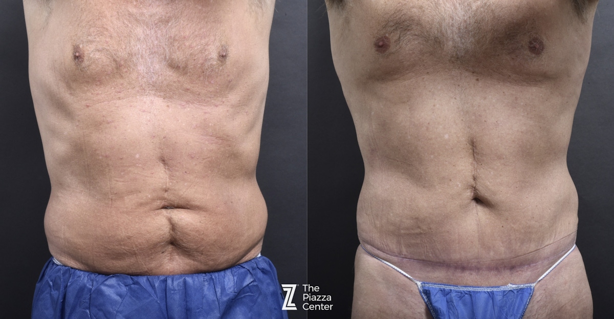Austin Liposuction Before & After Gallery - Patient 182165 - Image 1 - The Piazza Center